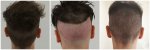 healing of donor area 2000 grafts 20 days.jpg