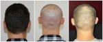 donor xavier full shave 2000 grafts.jpg