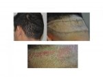 fue scarring.jpg