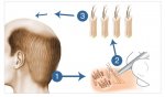 FOLLICULAR UNIT EXTRACTION Dubai.jpg