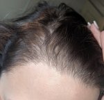 The Maitland Clinic Female hair transplant close up.jpg