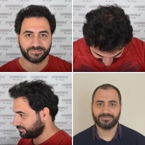 Dr Acar FUE Result