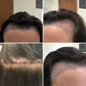 Female hairline - The Maitland Clinic