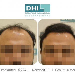 DHI Success Story  - Hair Transplant Before and After Results.