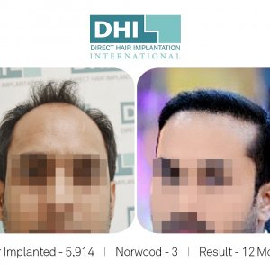 DHI Success Story 2  - Hair Transplant Before and After Results.