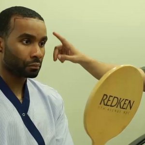 Afro Hair Transplant in Delhi Clinic With DHI-(Direct Hair Implantation) Technique