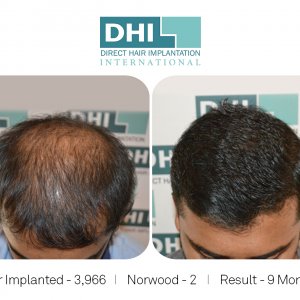 RANJITH GOWDA Hair Transplant Done By DHI Master Surgeon