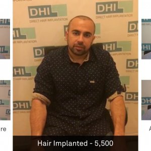 Siddharth Anand Shares His Feedback Regarding DHI Technique- Global Leader in Hair Transplant