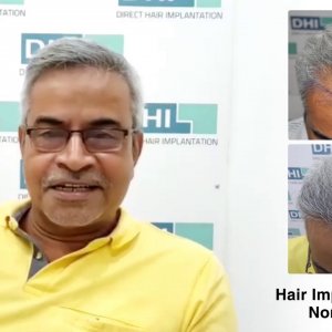 Ravi Shares His Feedback Regarding DHI Technique- Global Leader in Hair Transplant