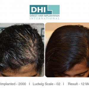 Female Hair Transplant Results - DHI