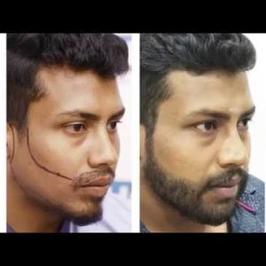 Beard Transplant & Restoration Case - DHI Direct Technique Beard Transplant