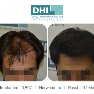 Hair Transplant Amazing Results