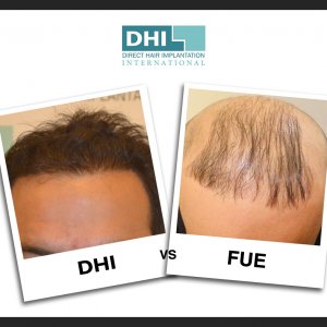 DHI vs FUE vs FUT : Key Differences Between DHI, FUE and FUT