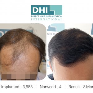 DHI - Hair Transplant Success Story 5