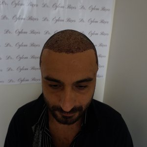FUE 3250 GREFT BY DR. BİCER