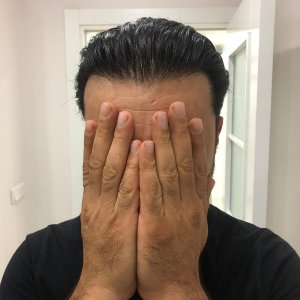 FUE 3250 GREFT BY DR. BİCER