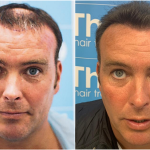 1. before-after-face. ben-thornley.png