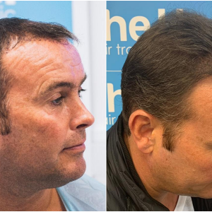 2. before-after-right. ben-thornley.png