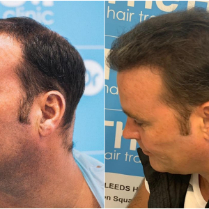 3. before-after-left. ben-thornley.png