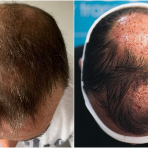 5. before-placement-top-ben-thornley.png