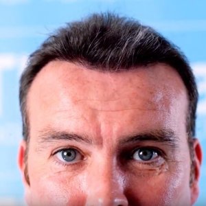 Ben-Thornley-Hair Transplant-Dr-Arshad.JPG