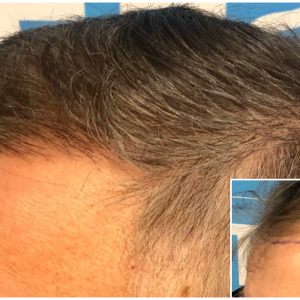 before-after-hairdr-dr-arshad-hairline-comp.png