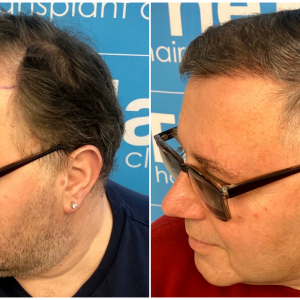 before-after-hairdr-dr-arshad-left.png