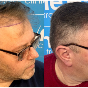 before-after-hairdr-dr-arshad-right.png