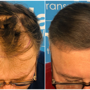 before-after-hairdr-dr-arshad-top.png