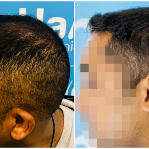 before-after-fut-hairdr-dr-arshad-left.png