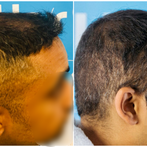 before-after-fut-hairdr-dr-arshad-right.png