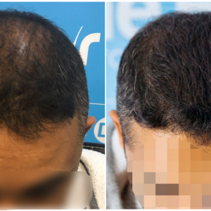 before-after-fut-hairdr-dr-arshad-top.png