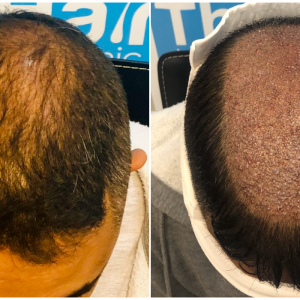 before-placement-fut-hairdr-dr-arshad-top.png