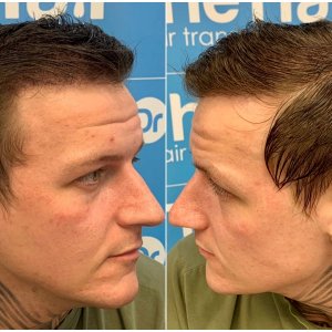 after-dr-arshad-hair-dr-fue-hair-transplant-left-right.face.jpg
