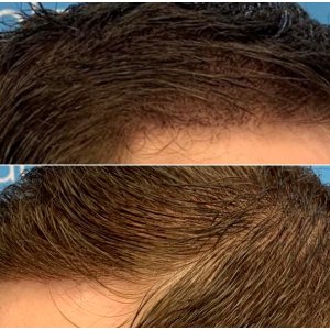 after-dr-arshad-hair-dr-fue-hair-transplant-left-right.jpg