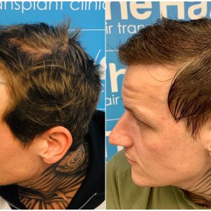 before-after-dr-arshad-hair-dr-fue-hair-transplant-left.jpg