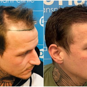 before-after-dr-arshad-hair-dr-fue-hair-transplant-right.jpg