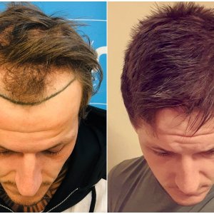 before-after-dr-arshad-hair-dr-fue-hair-transplant-top.jpg
