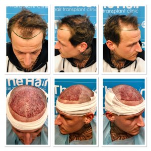 Before-raft-placement-fue-technique-dr-arshad-hair-dr-uk