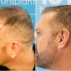 side-fue-hair-transplant-dr-arshad-hair-dr.jpg