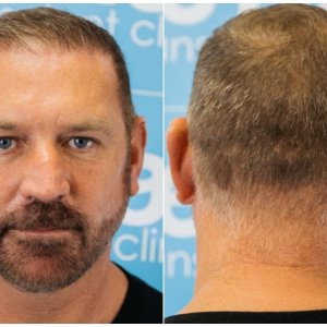 after-hairline-donor-before-dr-arshad-fue-hair-dr.jpg