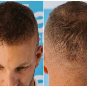 3500-FUE-Growth-Donor-Healing-snap-Dr-Arshad-Hair-Dr..jpg