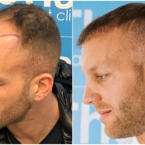 before-after-fue-hair-dr-dr-arshad-left.jpg