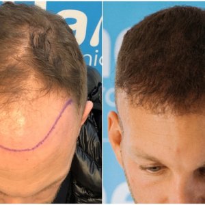 before-after-fue-hair-dr-dr-arshad-top.jpg