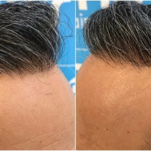 2148-fue-hair-dr-hairline.jpg