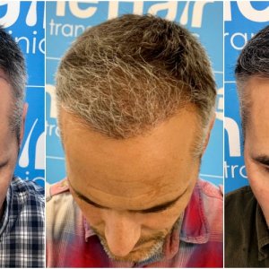before-6-months-11-months-2148-fue-hair-dr-face.jpg