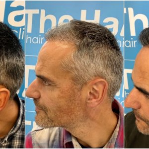before-6-months-11-months-2148-fue-hair-dr-left.jpg