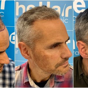 before-6-months-11-months-2148-fue-hair-dr-right.jpg