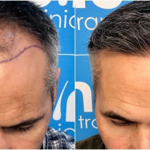 before-11-months-2148-fue-hair-dr-face.jpg