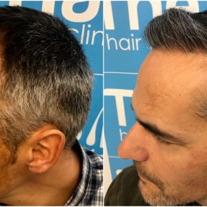 before-11-months-2148-fue-hair-dr-left.jpg